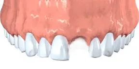 Dr. Jacobson, picture of avulsed tooth