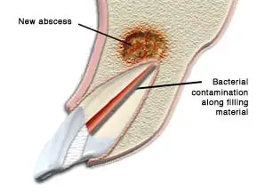 Dr. Jacobson, picture of abscessed endodontic treatment