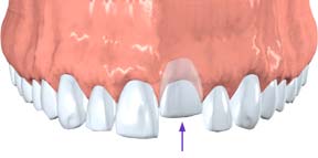 Dr. Jacobson, picture of dislodged tooth