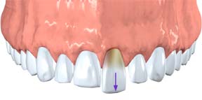 Dr. Jacobson, picture showing placement of dislodged tooth