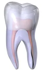 Dr. Jacobson, picture of tooth vertical root fracture