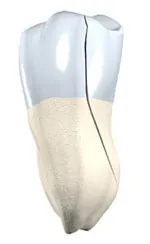 Dr. Jacobson, picture of split tooth